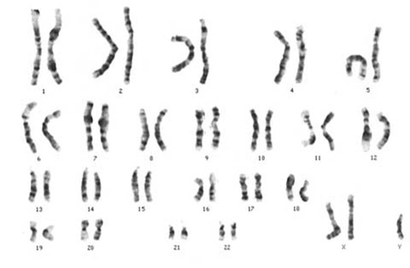 A karyogram showing the 47,XXY chromosomal complement associated with Klinefelter syndrome; mosaic and higher-grade variants also occur.