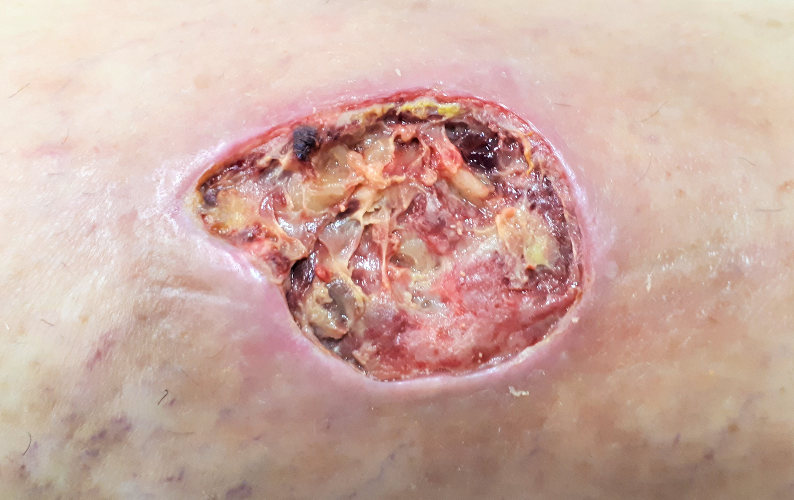 A clinical photograph of a chronic irregular venous leg ulcer with exudate, slough and granulation tissue, showing the surrounding venous skin changes and the importance of a full-limb assessment.