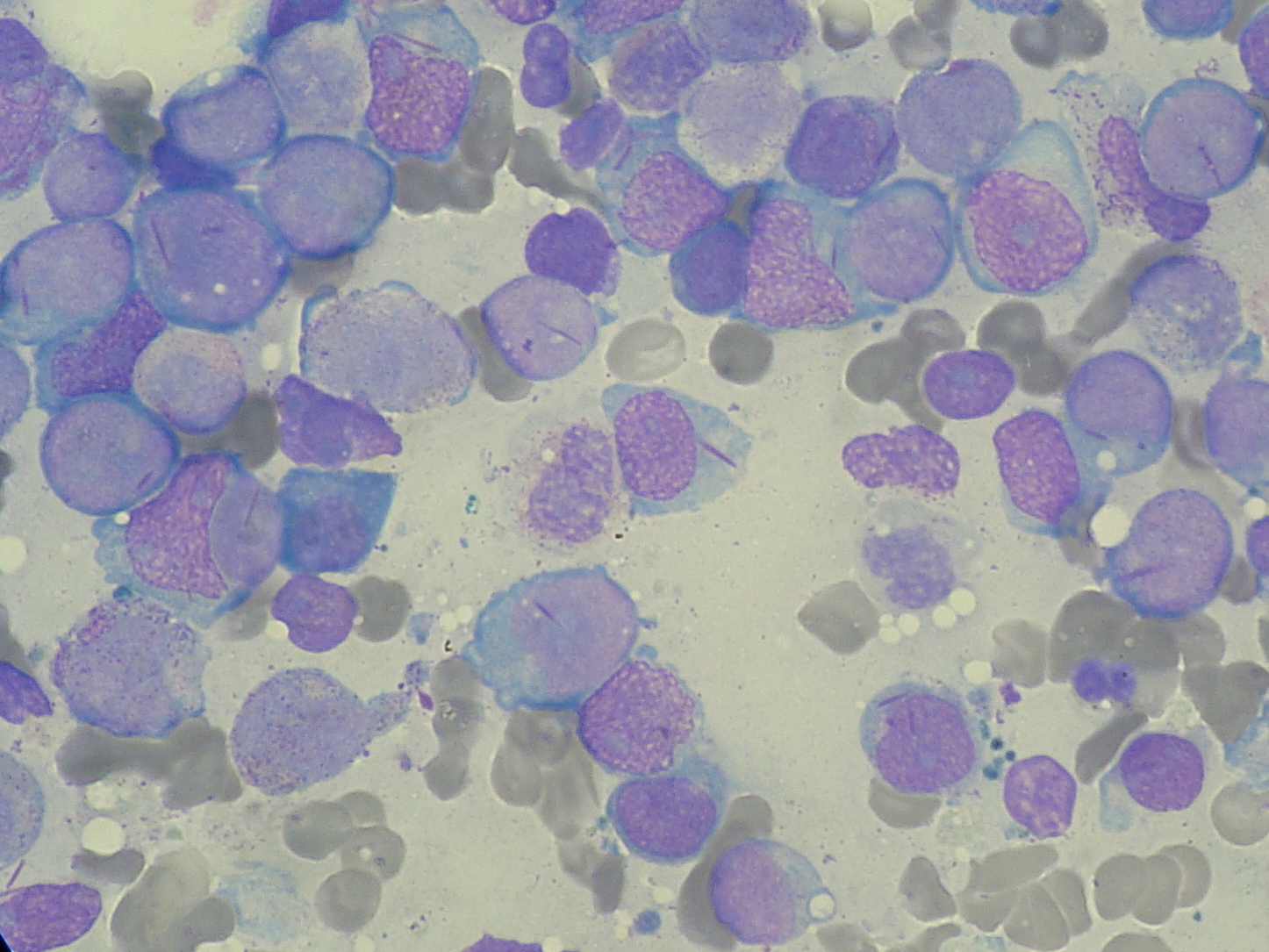 Blood film showing numerous immature myeloblasts, including cells with slender Auer rods, illustrating the maturation arrest and blast accumulation of acute myeloid leukaemia.