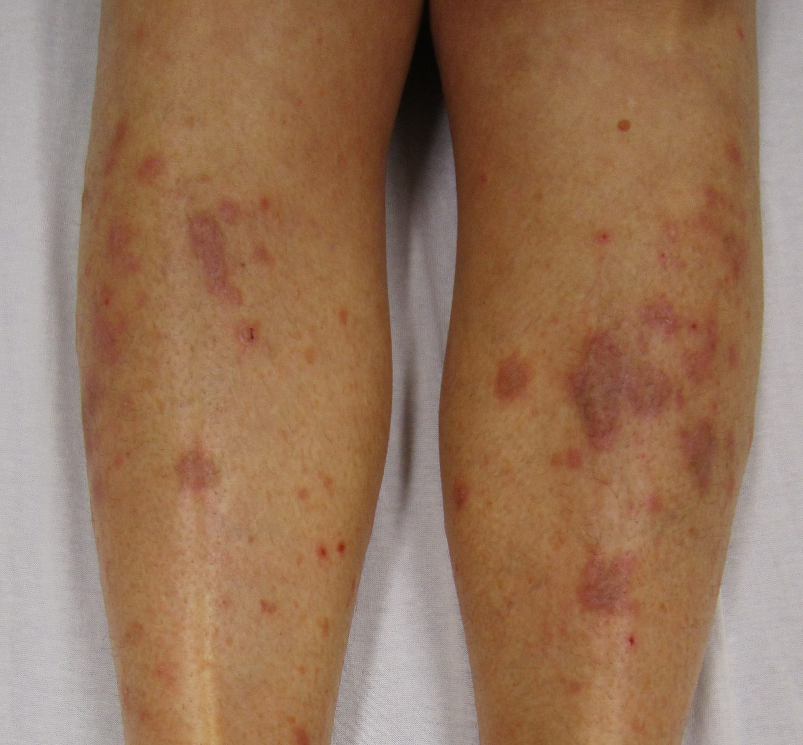A clinical photograph showing multiple bilateral violaceous to darker papules and plaques of cutaneous lichen planus on the lower legs, with fine surface striae where visible.