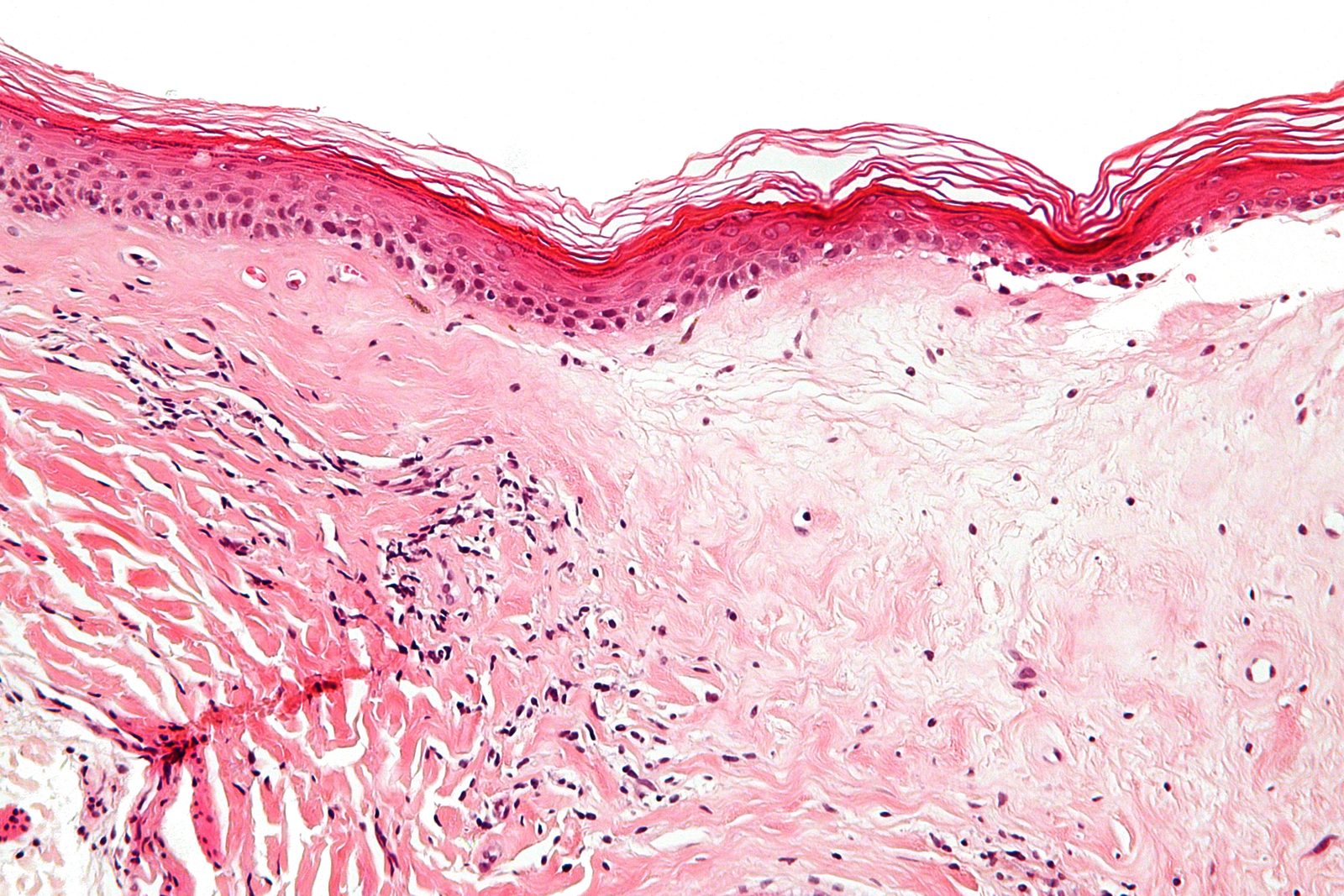 A histology image showing epidermal atrophy, a hyalinised upper dermis and a band of lymphocytes beneath.