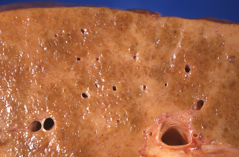 Explanted liver showing the diffuse nodularity of cirrhosis.