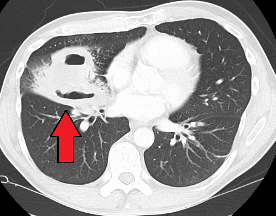 An axial lung-window CT showing a thick-walled intraparenchymal cavity with an air-fluid level and surrounding consolidation, consistent with a lung abscess.