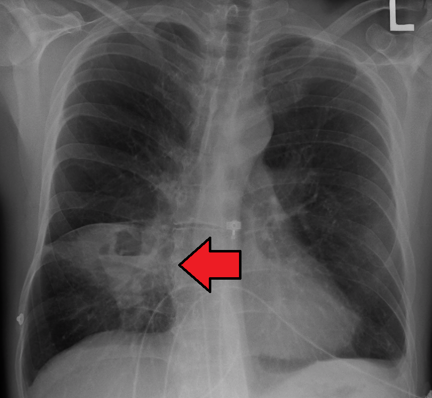A chest radiograph showing a thick-walled intraparenchymal cavity containing a horizontal air-fluid level in a dependent lung segment.