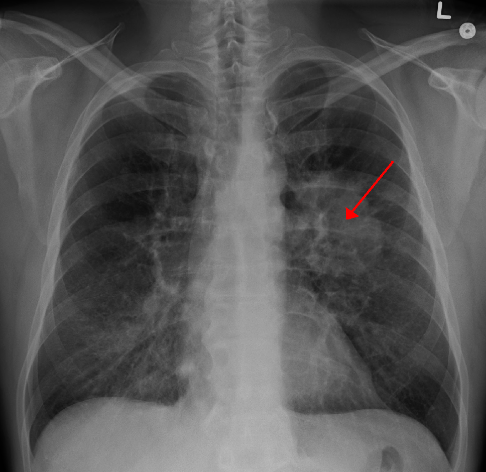 Posteroanterior chest radiograph showing an irregular left perihilar lung mass, marked by the red arrow, due to primary lung cancer.