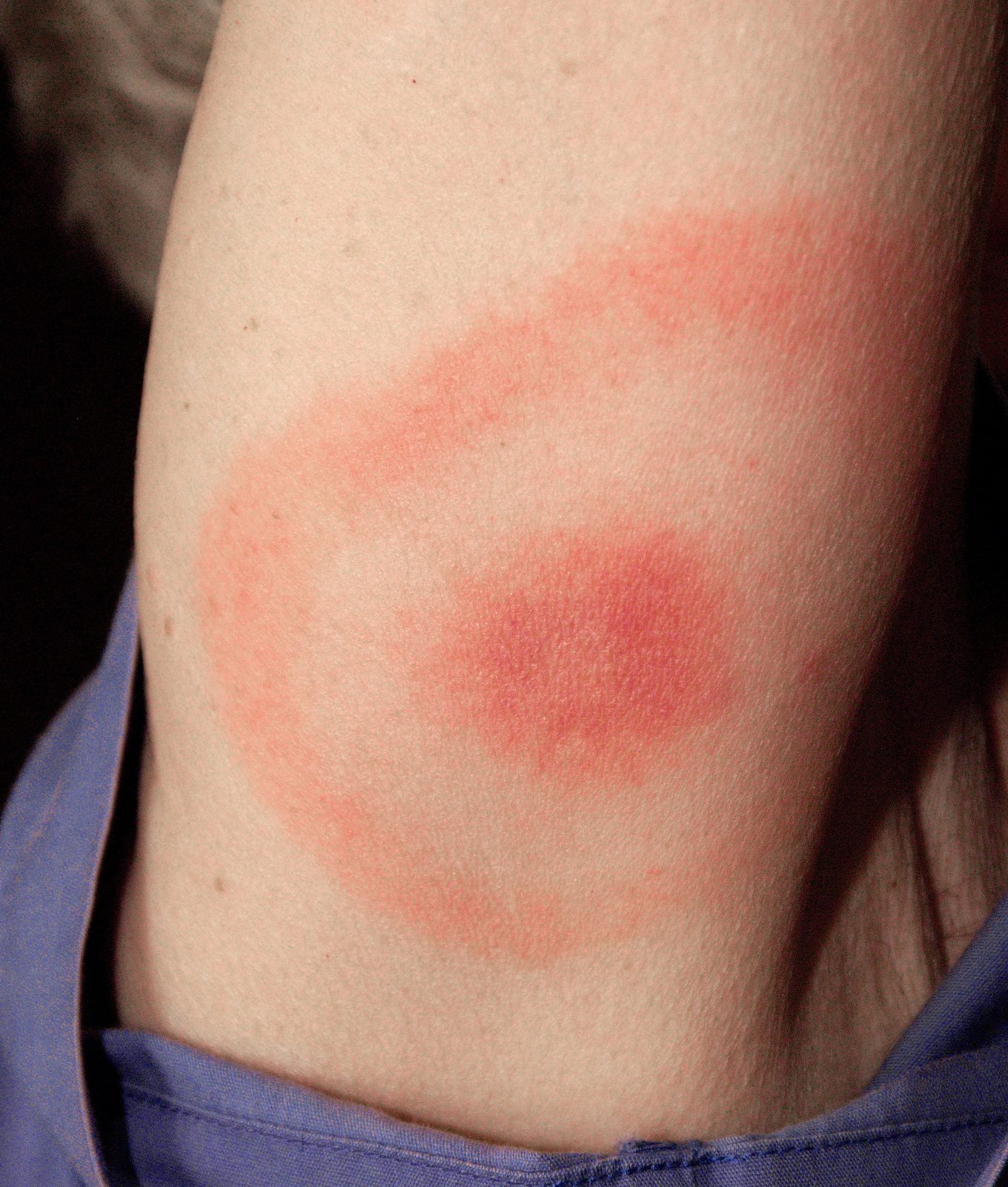 A clinical photograph of the expanding erythema migrans rash with central clearing at a tick-bite site, the hallmark of early Lyme disease.
