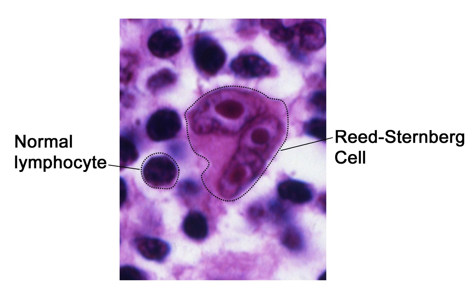 Photomicrograph of a lymph node biopsy showing binucleate Reed-Sternberg cells in a reactive background.