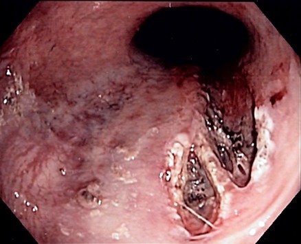 An endoscopic image showing a single longitudinal mucosal tear at the gastro-oesophageal junction, with labels distinguishing the superficial tear from the surrounding normal mucosa.