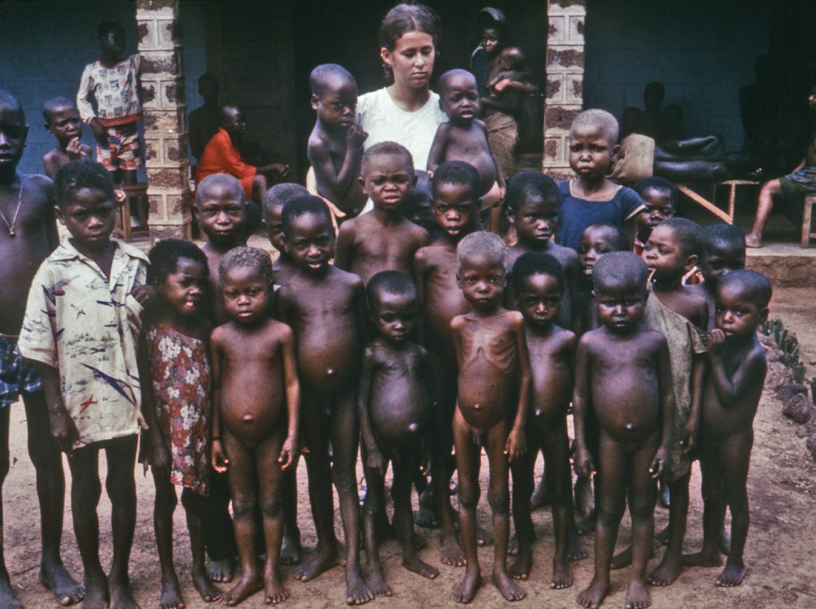 A clearly labelled paediatric clinical photograph showing severe protein-energy malnutrition and wasting. Use only as a visual example of phenotype, with adult nutrition-support guidance kept separate.