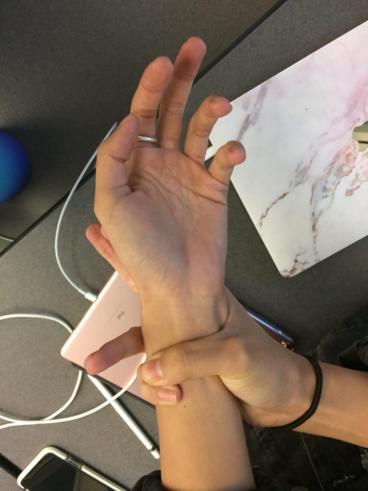 A clinical photograph demonstrating the positive Walker-Murdoch wrist sign, used as one systemic skeletal feature and not as a standalone diagnosis.
