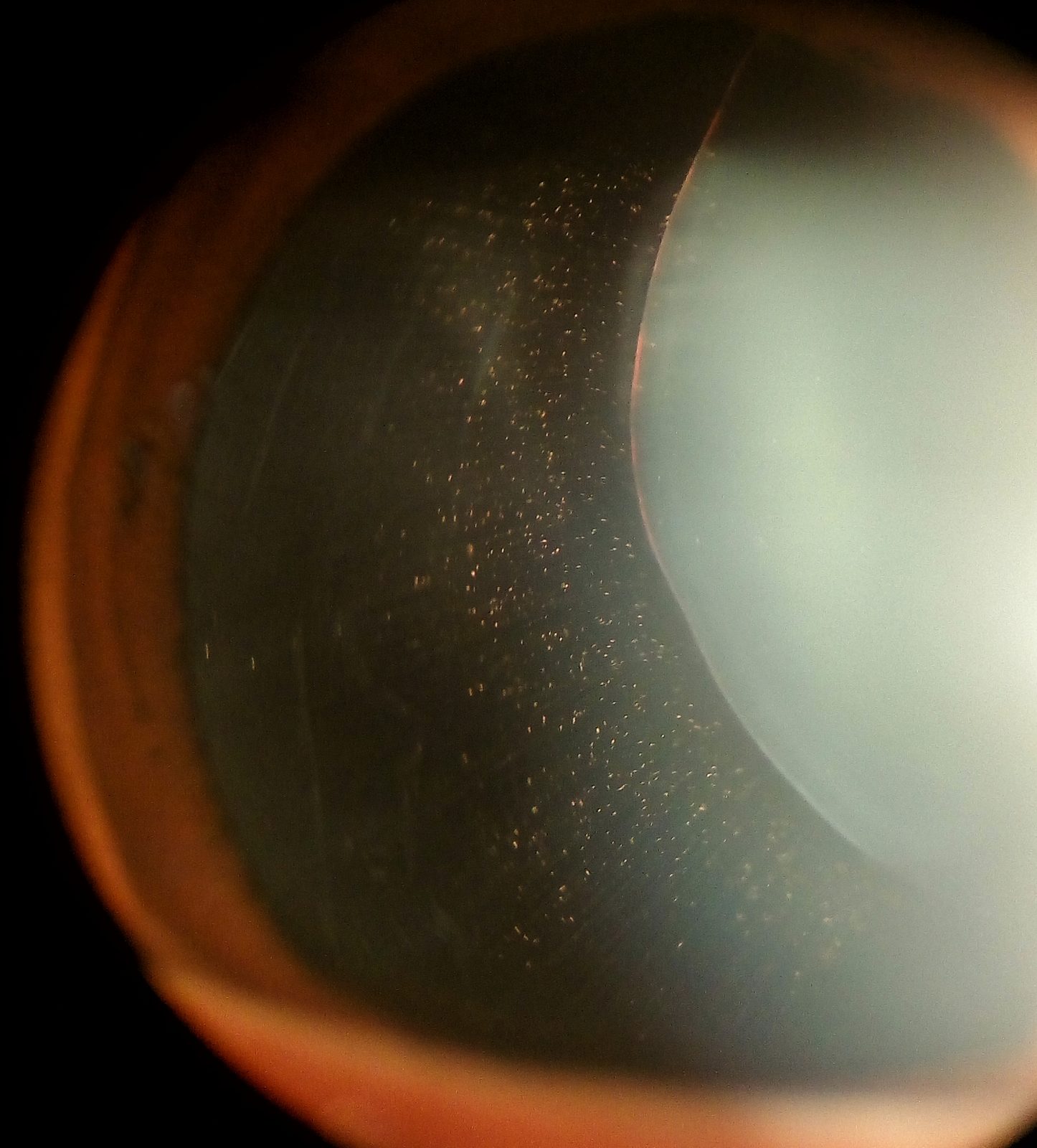 A slit-lamp image showing lens displacement, a specific ocular feature that must be interpreted within the revised Ghent diagnostic framework.