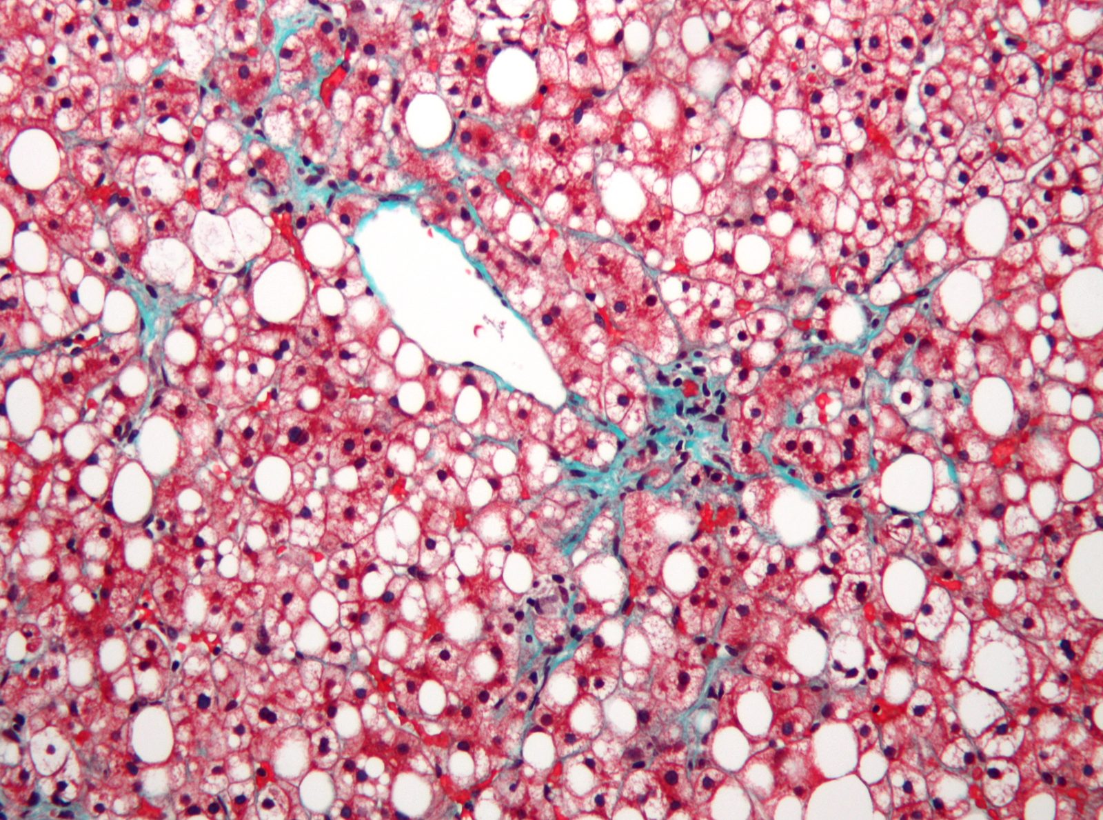 Trichrome-stained liver tissue showing steatosis and fibrous tissue, used to illustrate that fibrosis stage—not the visual amount of fat alone—drives prognosis and referral.