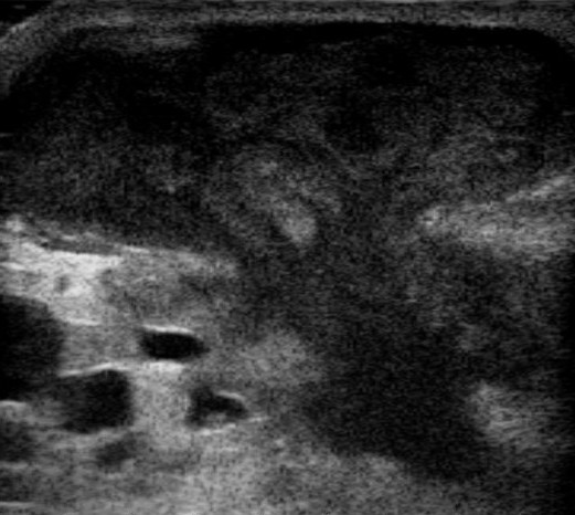 A breast ultrasound showing a well-defined fluid collection with internal echoes, annotated as a collection requiring specialist drainage rather than antibiotics alone.