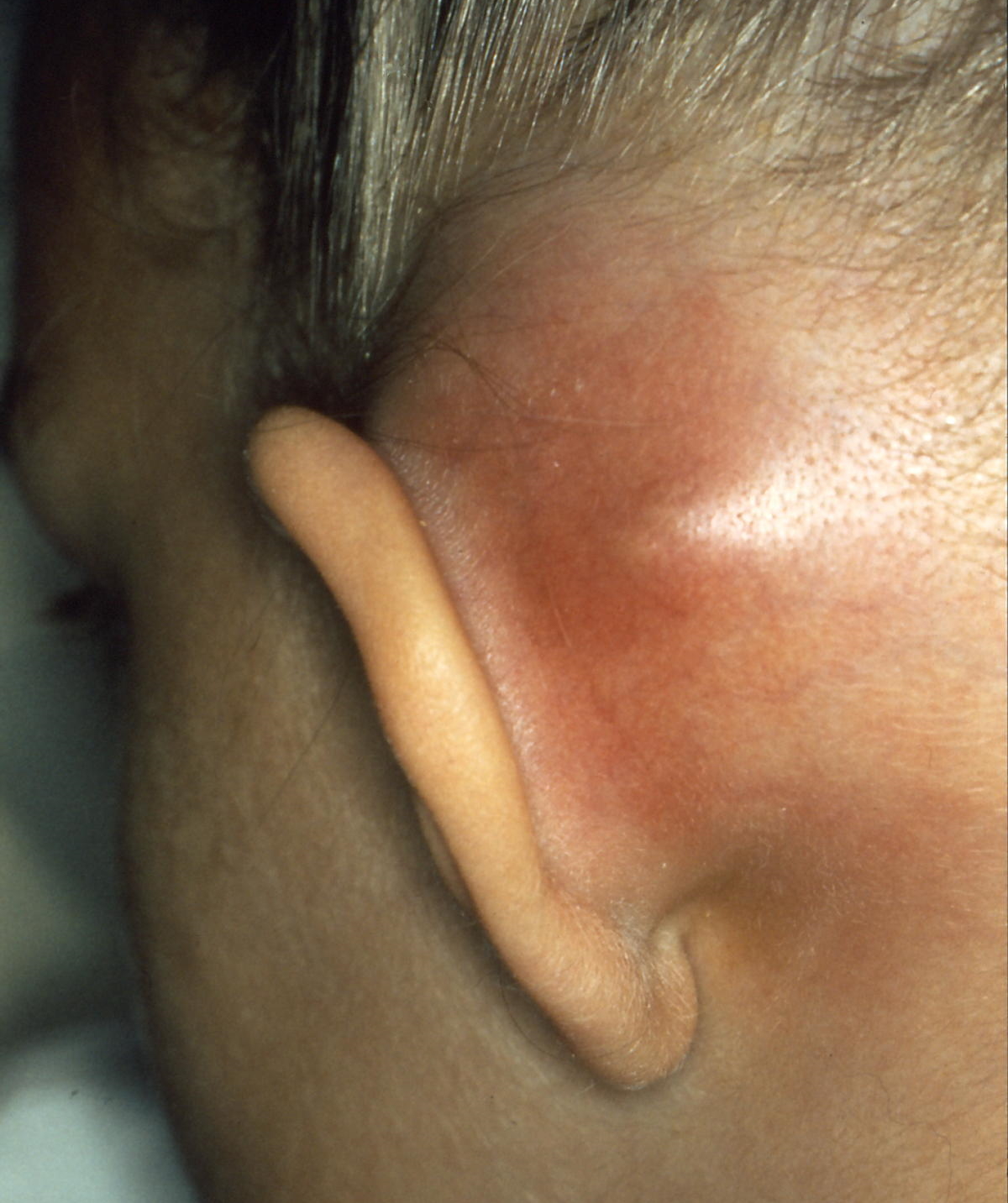 A clinical photograph showing post-auricular swelling and erythema pushing the pinna forwards and outwards, with loss of the post-auricular crease.