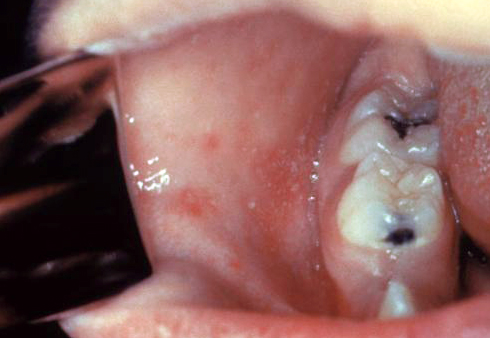 Clinical photograph of small white Koplik spots on the buccal mucosa, pathognomonic of measles and appearing before the rash.
