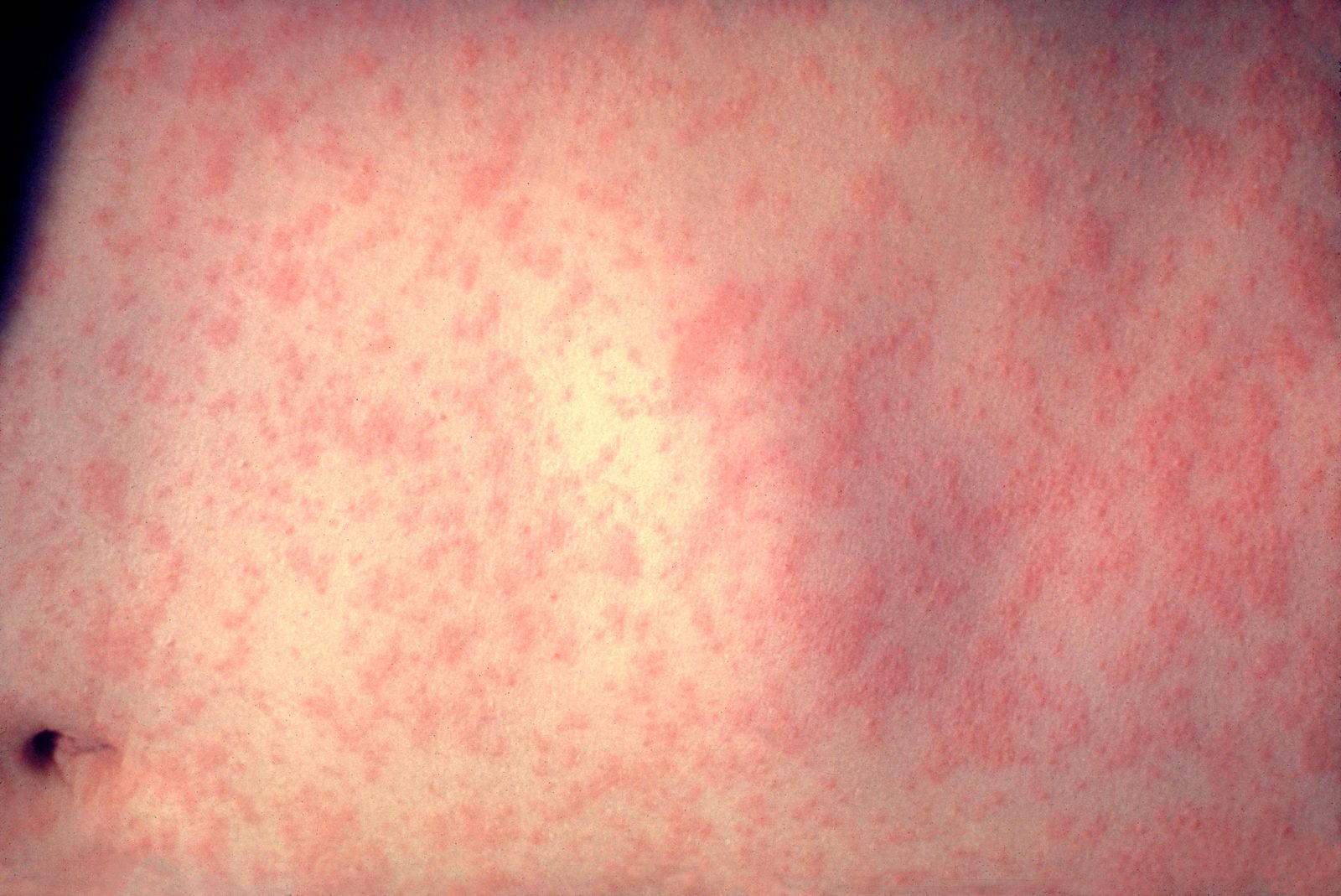 A clinical photograph showing the widespread erythematous maculopapular, partly confluent rash of measles across the trunk.