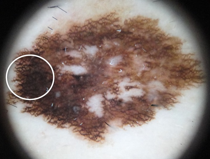 Dermoscopy of a superficial spreading melanoma showing an atypical, broadened pigment network, irregular pigmentation and white regression areas.