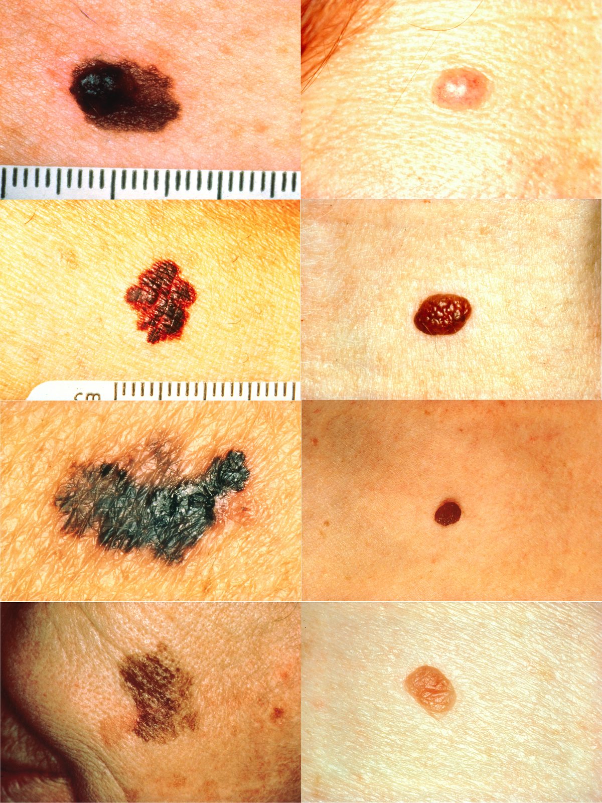 Side-by-side clinical photographs comparing a benign naevus with a melanoma showing asymmetry, border irregularity and colour variation.
