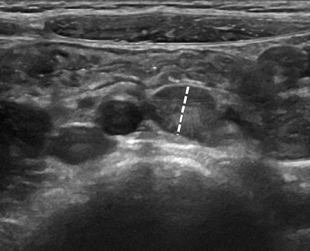 Abdominal ultrasound showing several enlarged hypoechoic mesenteric lymph nodes; the image should be labelled as non-specific and not diagnostic of mesenteric adenitis alone.