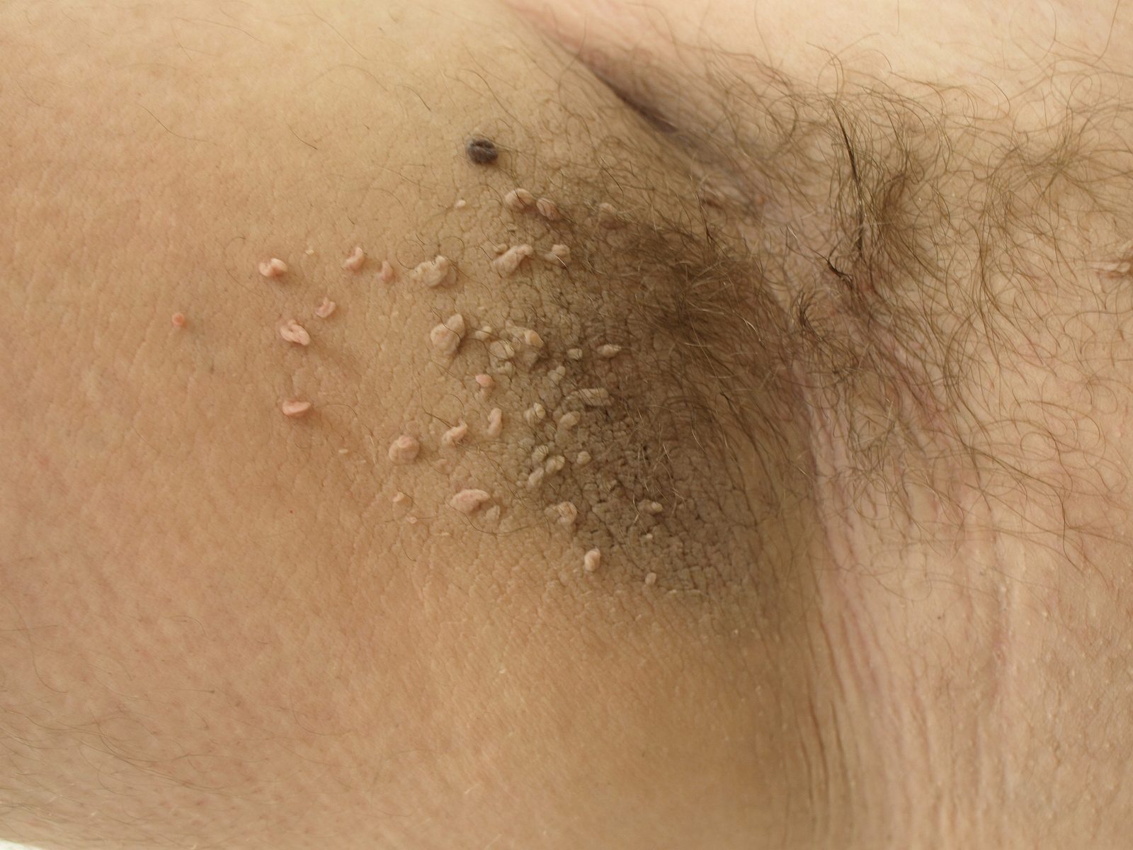 Axillary acanthosis nigricans with velvety hyperpigmented thickening and skin tags, a clinical marker associated with insulin resistance and obesity.