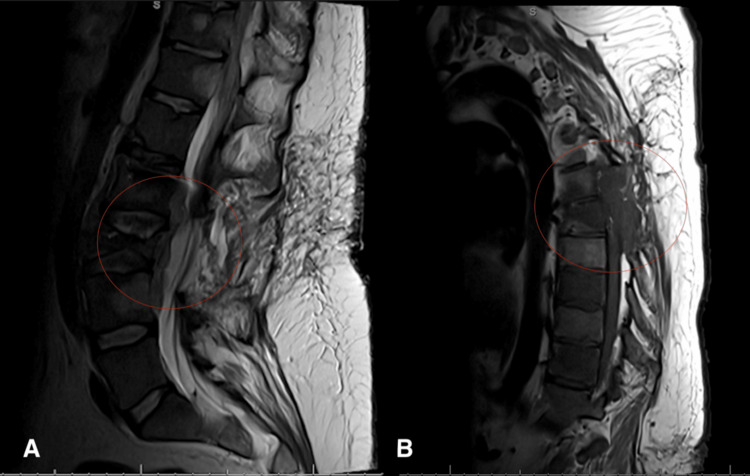 Sagittal lumbar and thoracic MRI panels showing vertebral metastatic disease extending into the epidural space, causing severe canal narrowing and thecal-sac or cord compression.