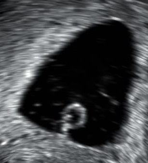 Transvaginal ultrasound showing an empty gestational sac in early pregnancy loss, with a reminder that an uncertain scan must be repeated according to NICE safeguards before diagnosing miscarriage.