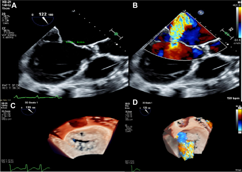 Transoesophageal echocardiography showing a large eccentric systolic colour-Doppler jet through the mitral valve, with complementary 3D valve views.