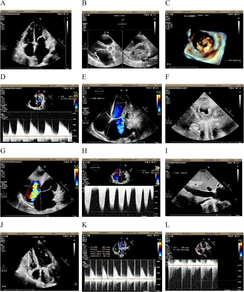 Echocardiographic panels demonstrating a markedly reduced mitral valve area and high transmitral Doppler velocity, with secondary right-sided pressure overload.