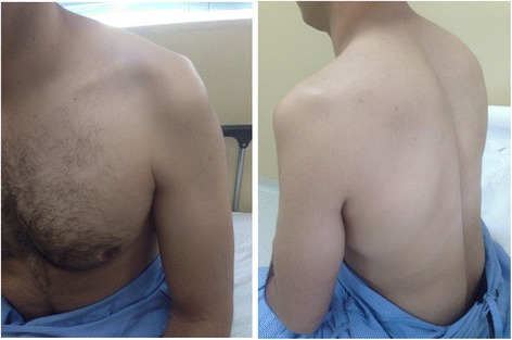Anterior and posterior clinical views showing marked unilateral atrophy of the left deltoid, supraspinatus and infraspinatus muscles in monomelic amyotrophy, a focal motor-neuron disorder. Use this as a differential illustration rather than a typical image of MND.