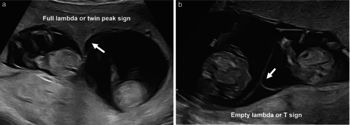 First-trimester ultrasound comparing the lambda sign of dichorionic twins with the T-sign of monochorionic diamniotic twins, with a note that amnionicity must also be established.