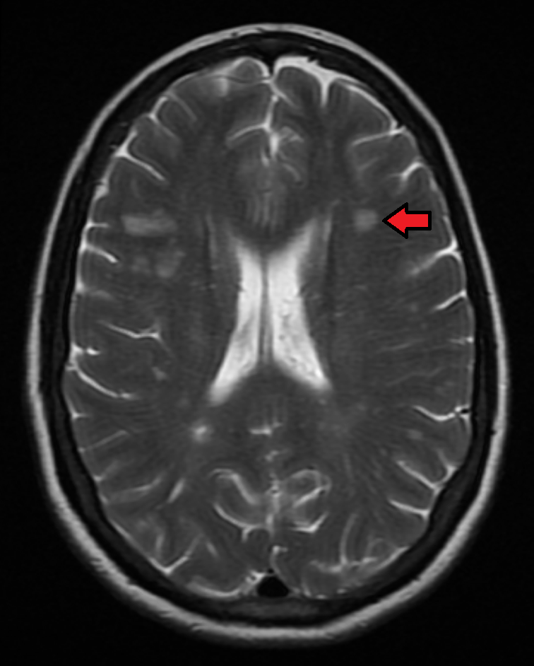 Axial brain MRI showing periventricular and juxtacortical white-matter lesions, illustrating characteristic lesion topography in multiple sclerosis.