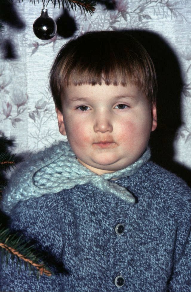 Clinical photograph of parotid-region swelling broadening the lower face and obscuring the angles of the jaw; retain source attribution while image-quality remediation remains separate.