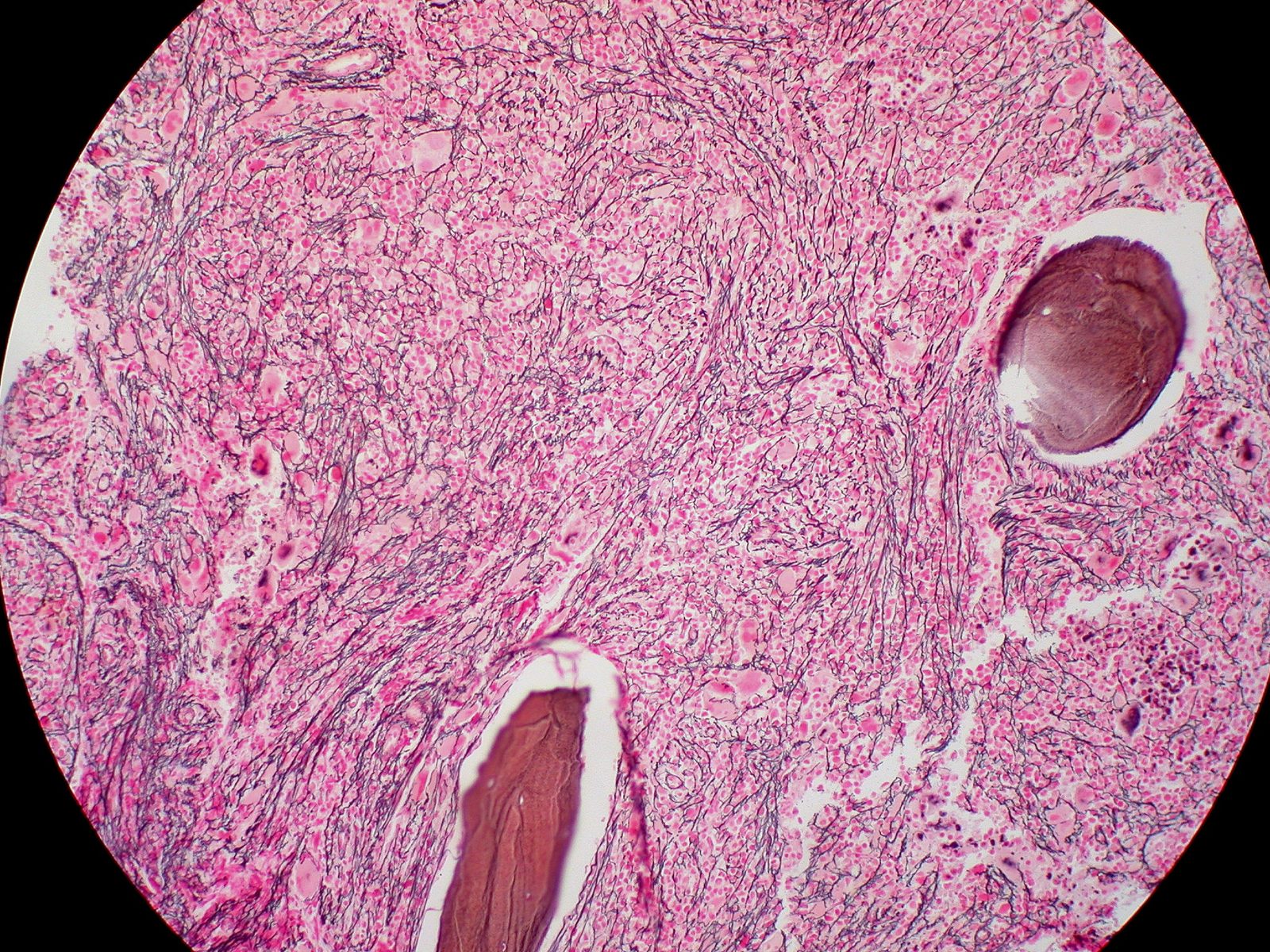 A bone marrow trephine with a reticulin stain showing dense fibrosis and clustered atypical megakaryocytes replacing normal marrow.