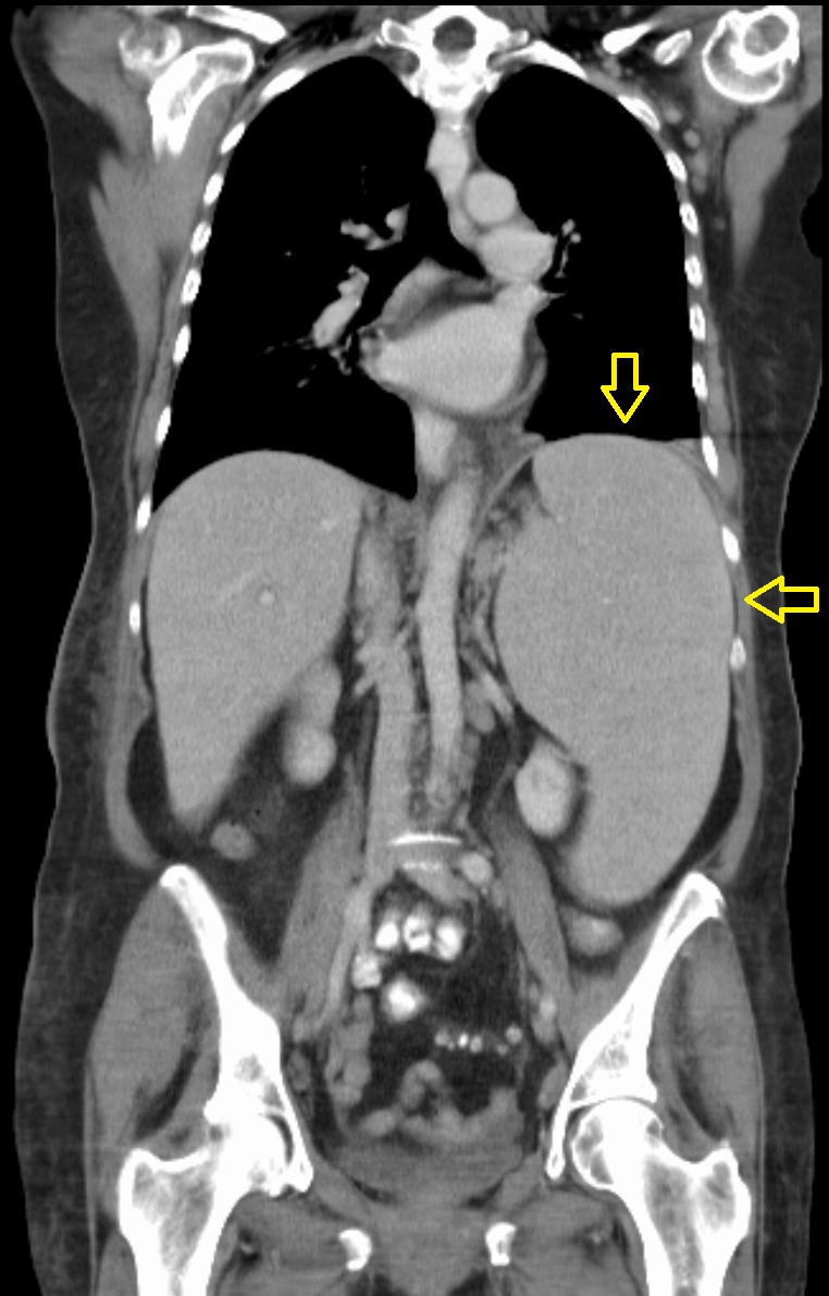 An illustration or image of massive splenomegaly extending below the umbilicus from extramedullary haematopoiesis.