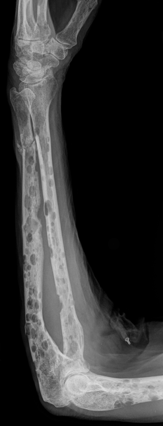 Radiograph showing multiple well-defined lytic lesions characteristic of myeloma bone disease.