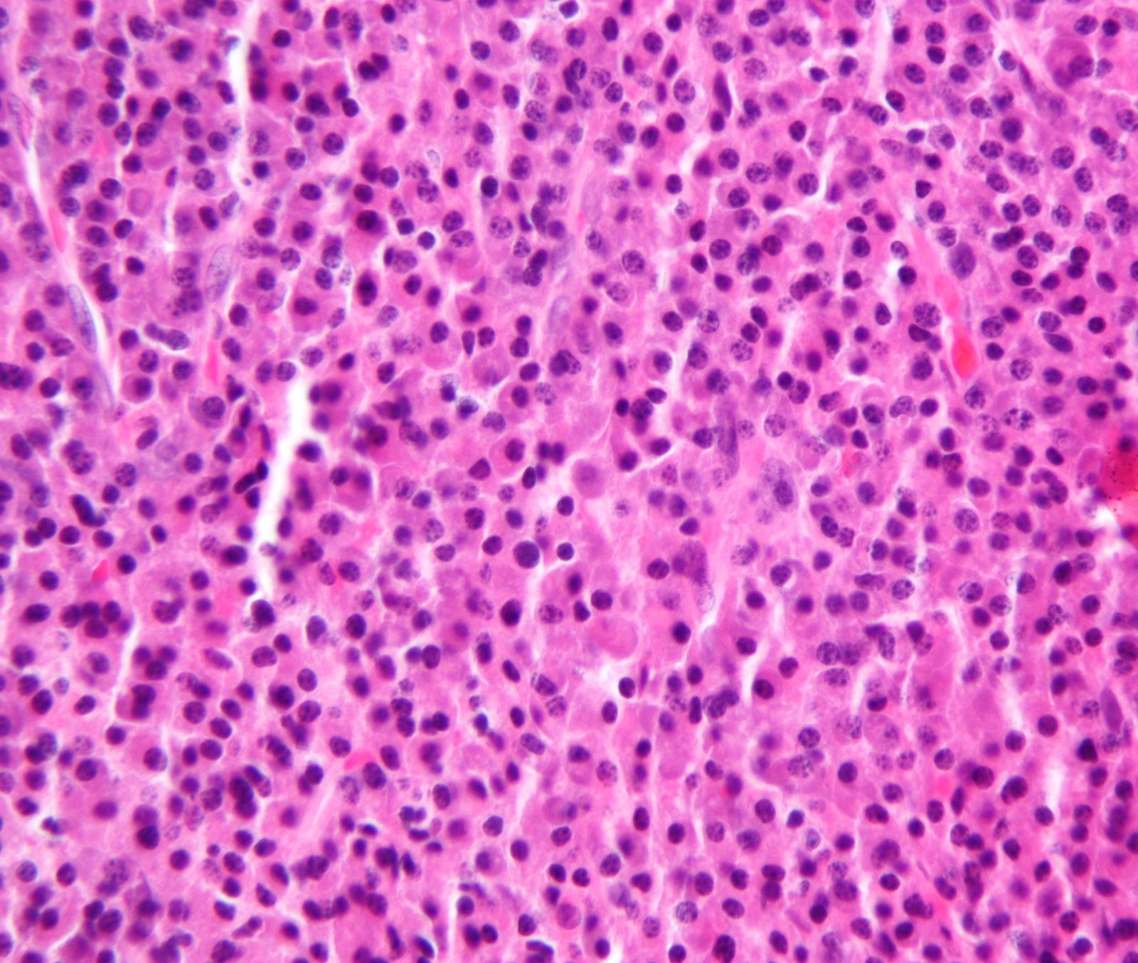 Bone marrow aspirate showing an excess of abnormal plasma cells in multiple myeloma.