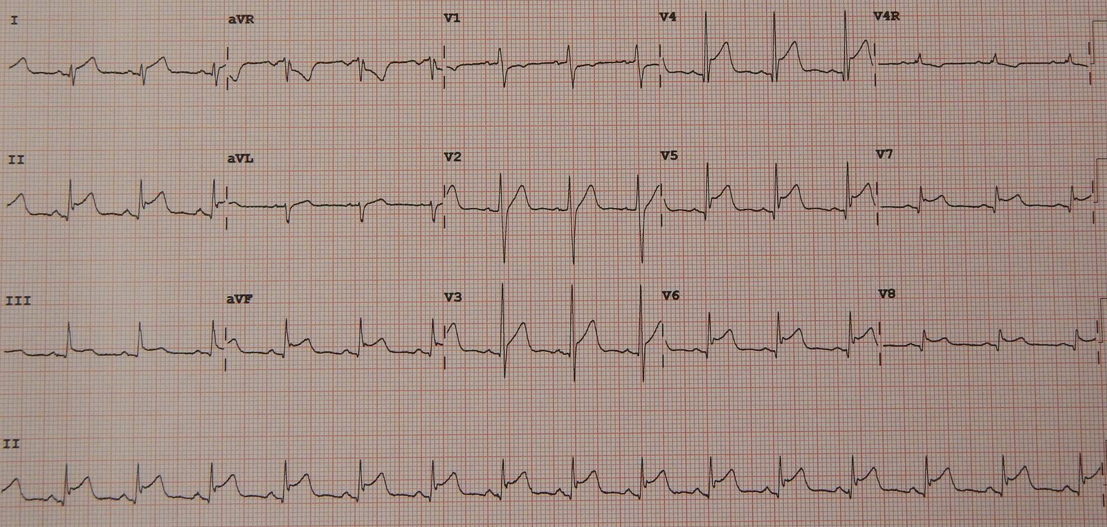 Twelve-lead ECG from a patient with myopericarditis showing widespread concave ST-segment elevation rather than a single coronary-territory pattern; the legend should warn that ECG pattern alone does not exclude acute coronary syndrome.