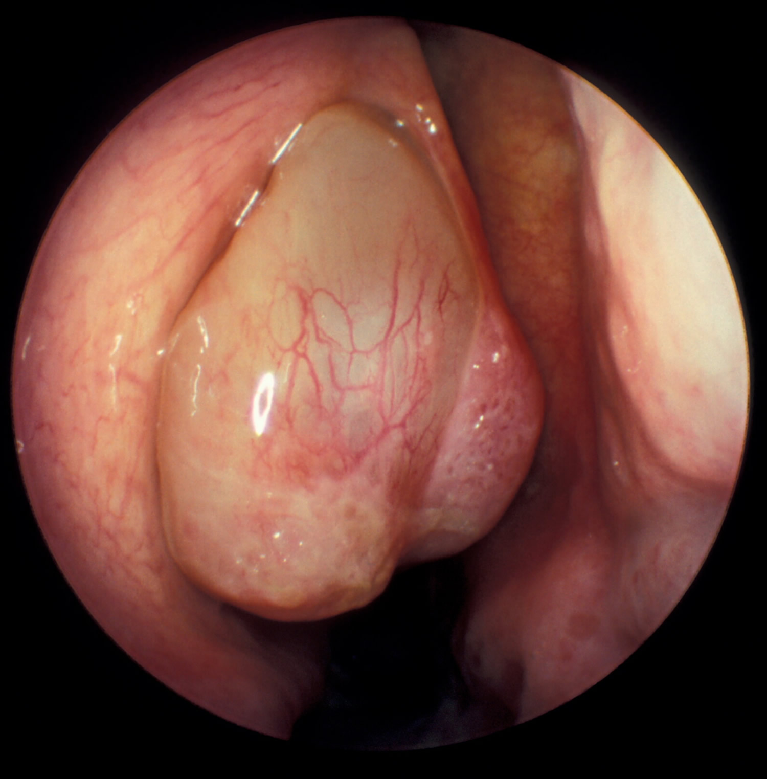 An endoscopic view showing a large pale, glistening nasal polyp arising from the middle meatus and prolapsing into the nasal cavity.