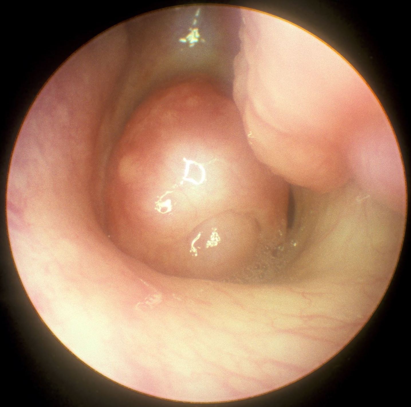 A coronal CT of the sinuses showing polypoid mucosal opacification of the nasal cavity and paranasal sinuses.