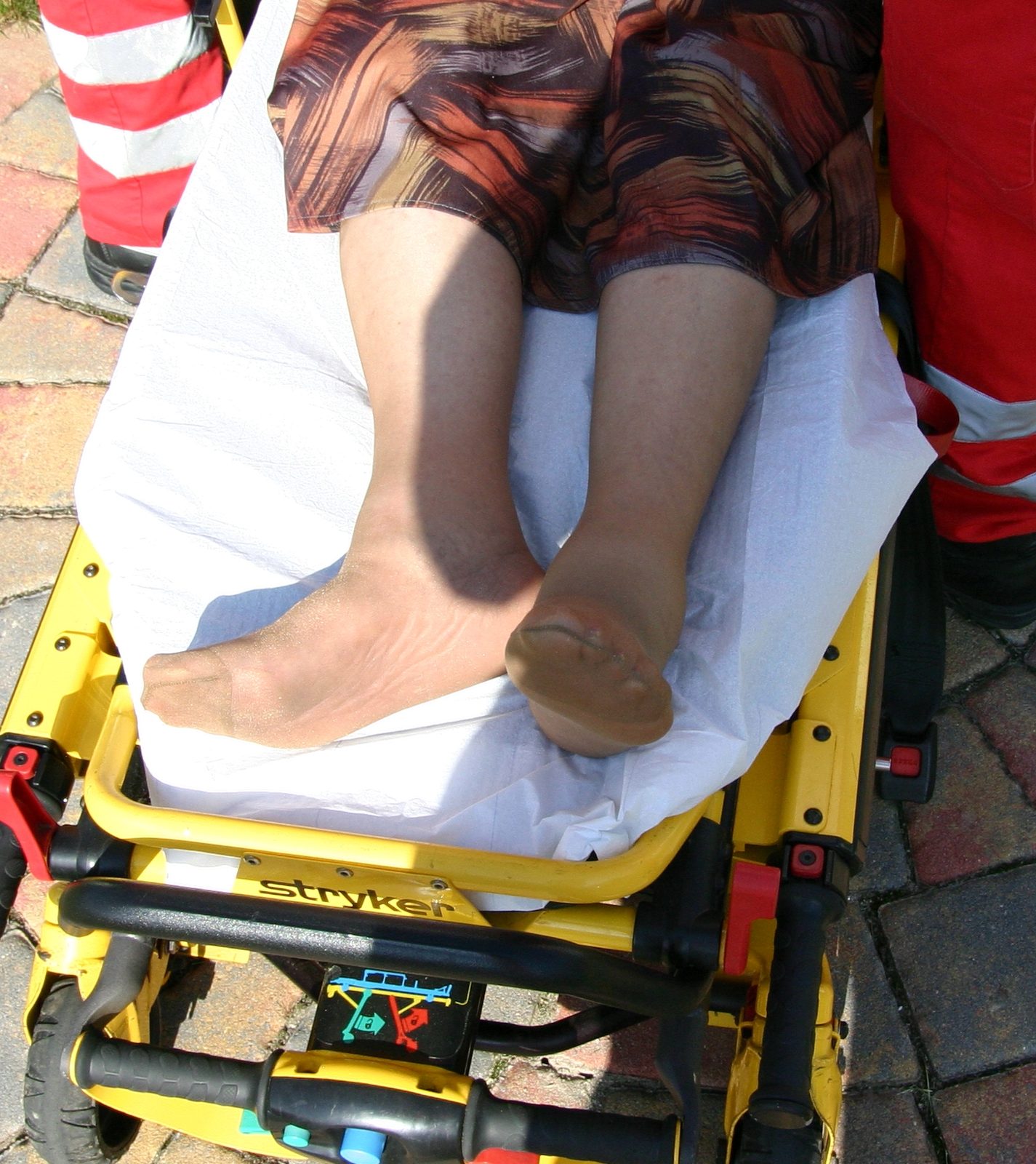 Clinical photograph showing the classic limb position of a displaced intracapsular neck of femur fracture.