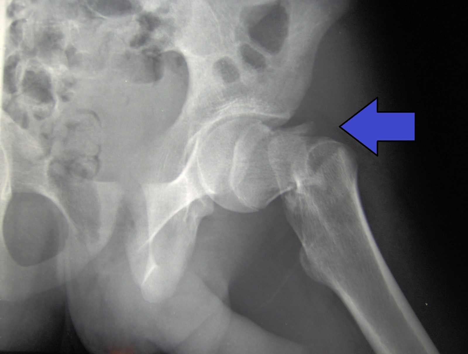 Radiograph demonstrating a displaced subcapital fracture with disruption of the normal femoral-neck contour and Shenton's line.