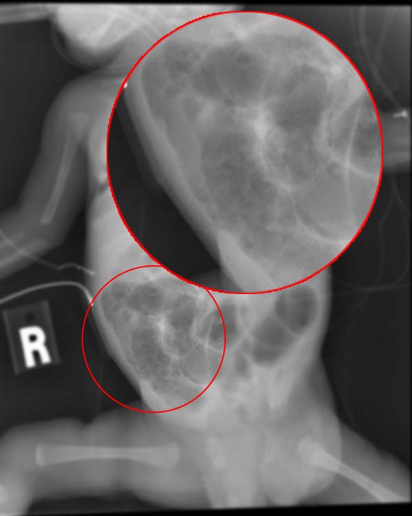 A neonatal abdominal radiograph showing intramural gas with dilated bowel loops, labelled as a highly suggestive sign of NEC rather than an isolated substitute for clinical assessment.