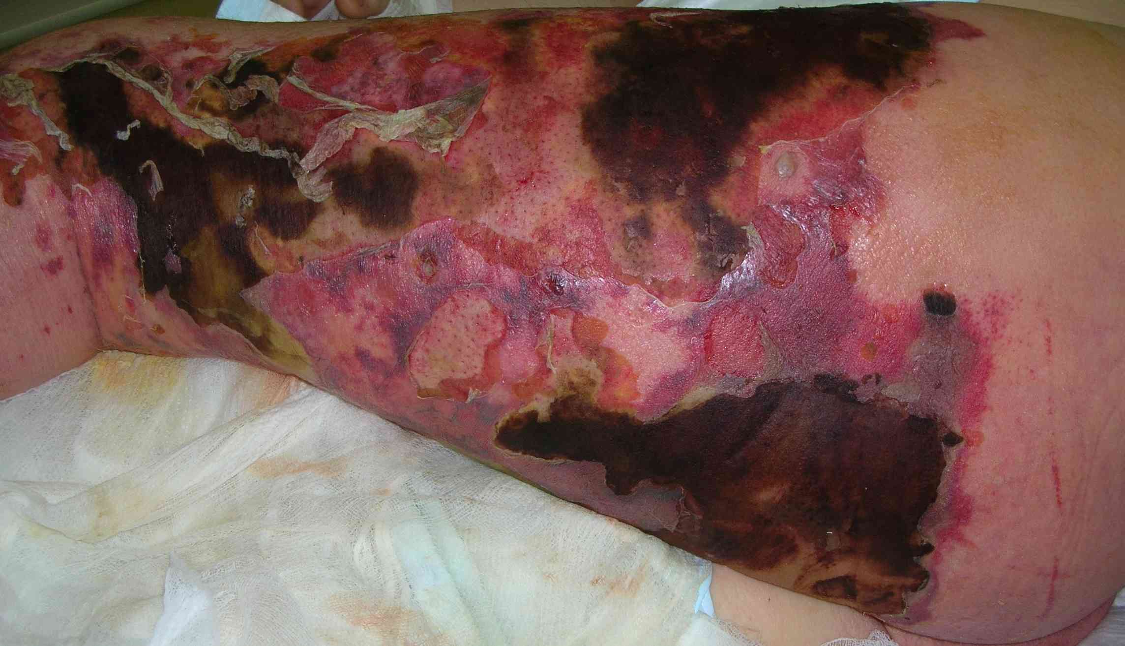 A sensitive pre-operative clinical photograph showing dusky erythema, haemorrhagic bullae, epidermal sloughing and black skin necrosis in advanced necrotising fasciitis.