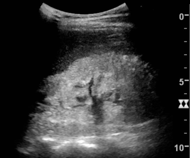 Clinical pathway linking heavy proteinuria to oedema, thrombosis, infection, AKI and CKD, with investigation and escalation points for renal-vein thrombosis, pulmonary embolism and hypovolaemia.