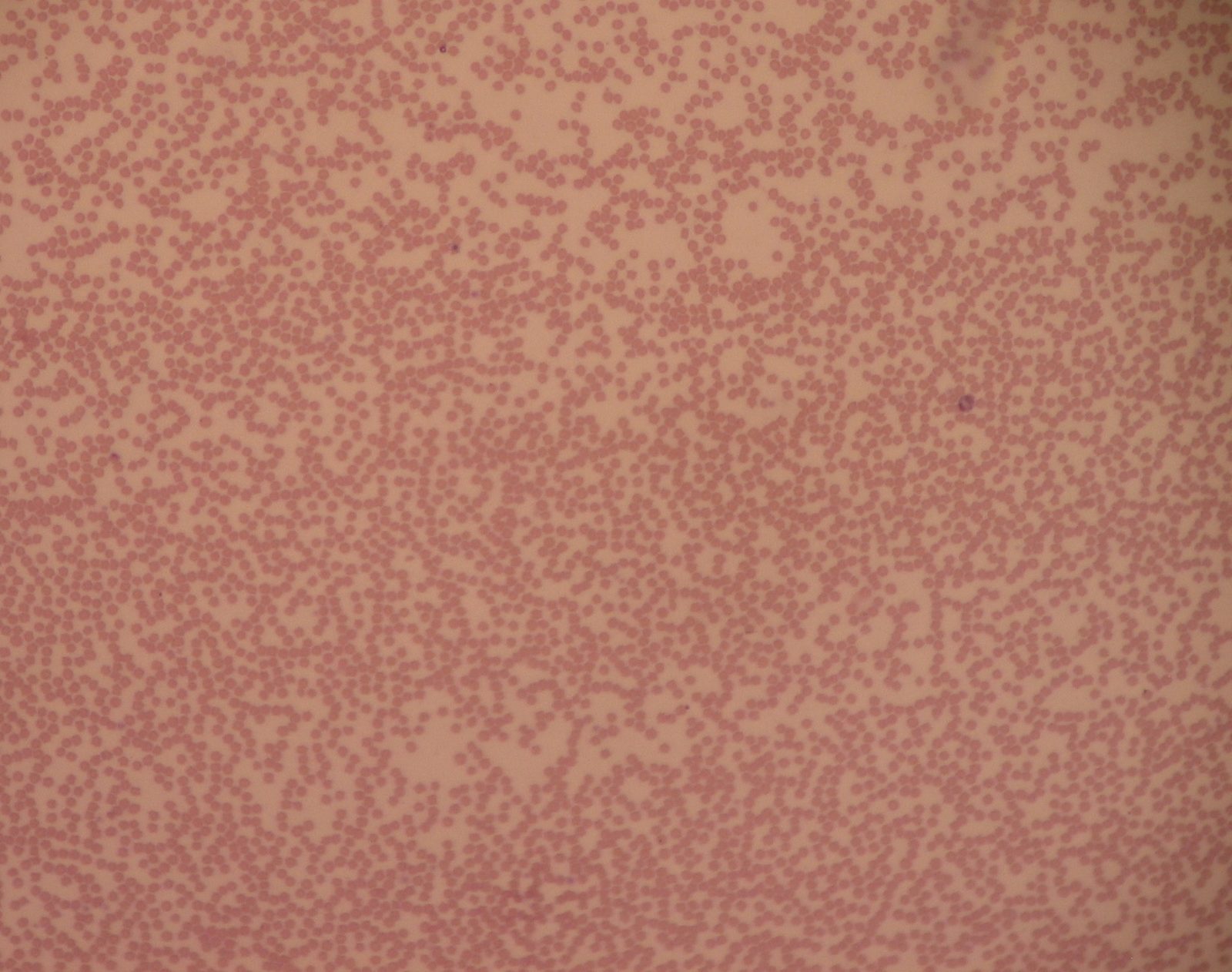 Peripheral blood film at low power demonstrating markedly reduced neutrophils after marrow suppression; correlate with the FBC differential.