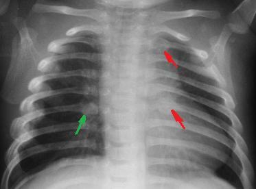 Infant chest radiograph showing posterior rib fractures. Image interpretation must be by an experienced paediatric radiologist within the full clinical and safeguarding assessment.