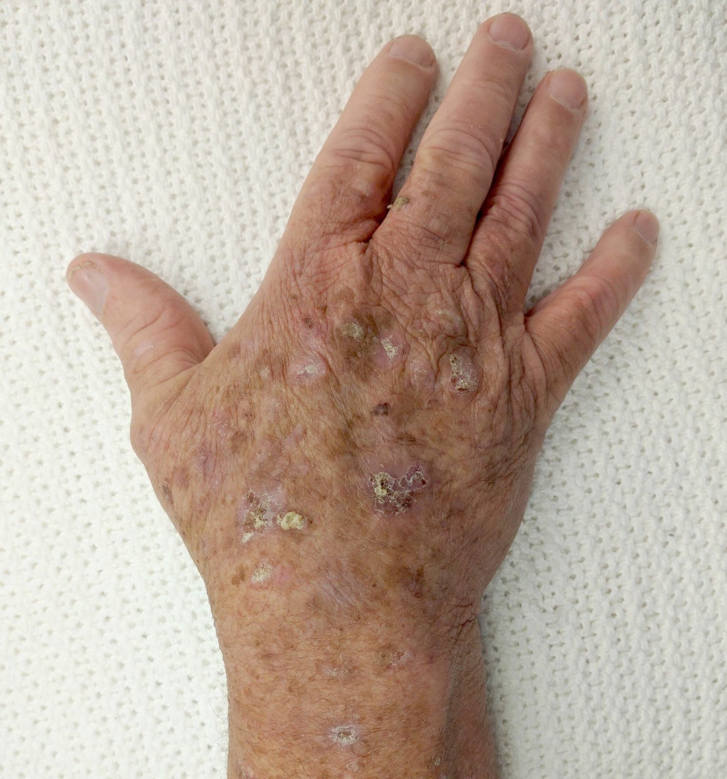 Clinical photograph of a rough, scaly, erythematous patch on sun-exposed skin, the premalignant precursor to cutaneous squamous cell carcinoma.
