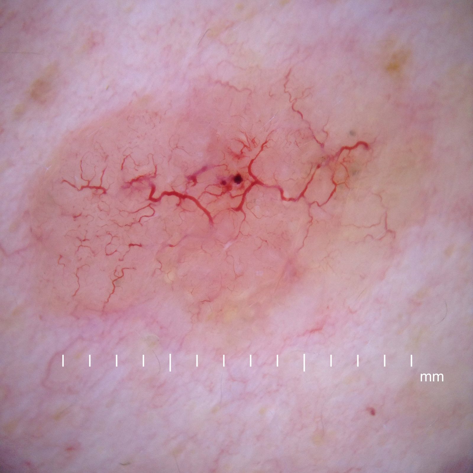 Dermoscopic image of a nodular basal cell carcinoma showing branching (arborising) telangiectatic vessels over a translucent pink background, a characteristic feature.