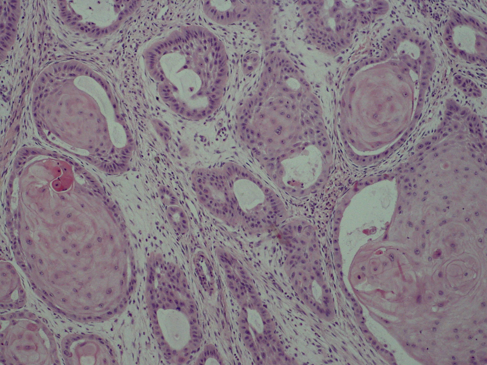 Haematoxylin and eosin section showing invasive nests of atypical keratinocytes with concentric keratin pearls, typical of well-differentiated cutaneous squamous cell carcinoma.