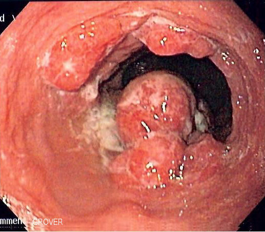 Endoscopic view of an irregular ulcerated exophytic oesophageal carcinoma narrowing the lumen.